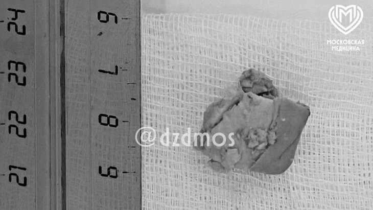 Столичные врачи спасли мальчика, у которого в пищеводе застрял кусок сосиски