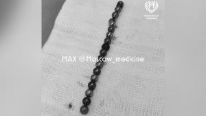 Столичные врачи извлекли из живота четырехлетнего мальчика 19 магнитов