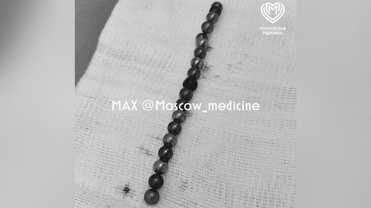 Столичные врачи извлекли из живота четырехлетнего мальчика 19 магнитов