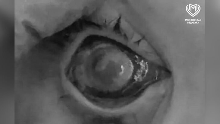 Московские врачи вернули зрение двум подросткам после ожогов из-за эксперимента