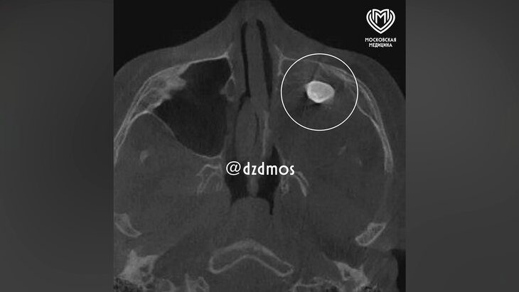 Московские врачи удалили подростку выросший в носу зуб